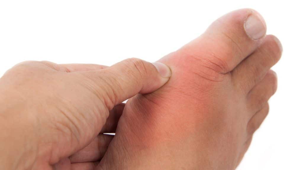 It’s Possible To Heal Gout