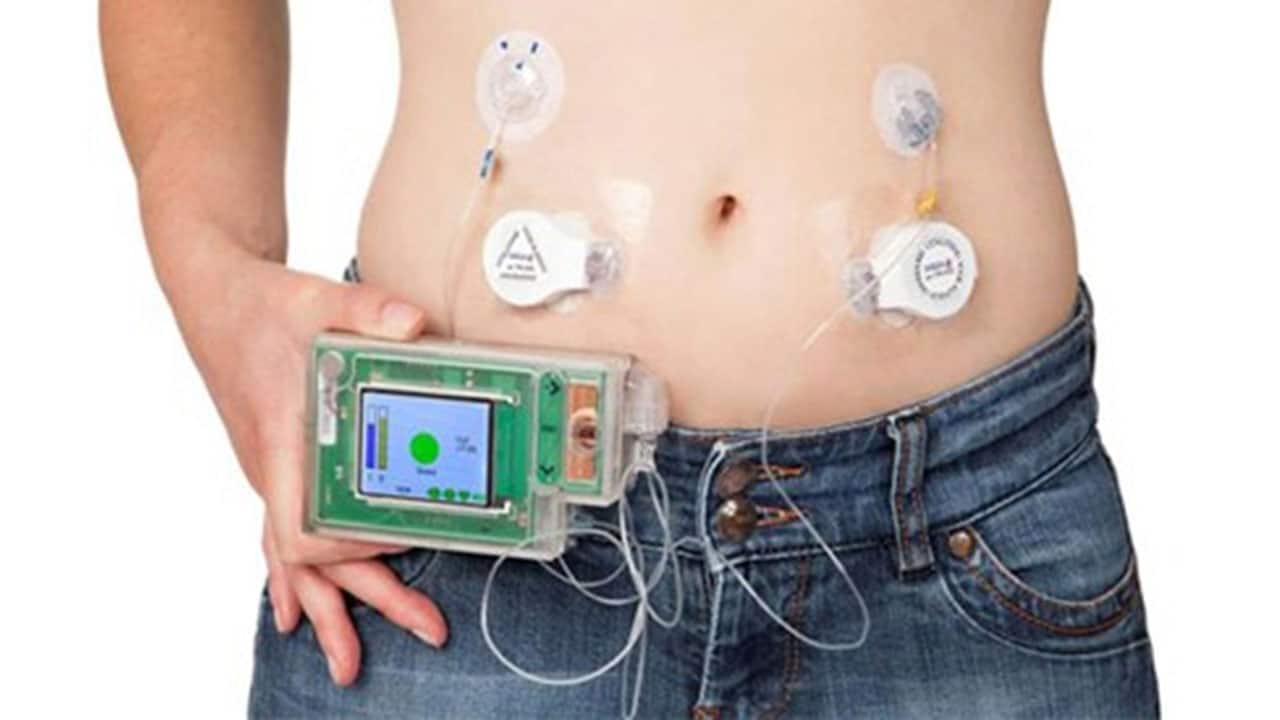 Artificial Pancreas Asa Andrew